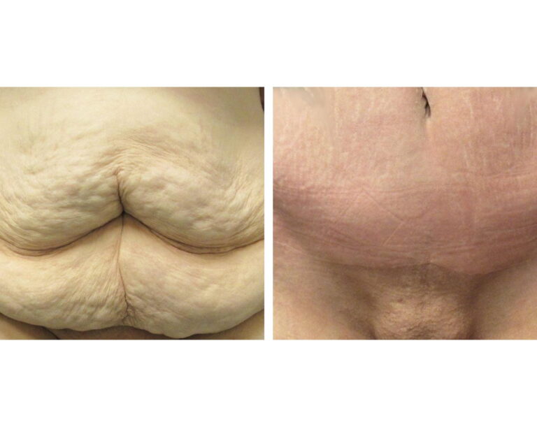 Tummy Tuck | Bismarck, Minot, Dickinson ND - Aesthetic Center