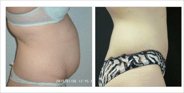 Body Enhancement Treatment in North Dakota