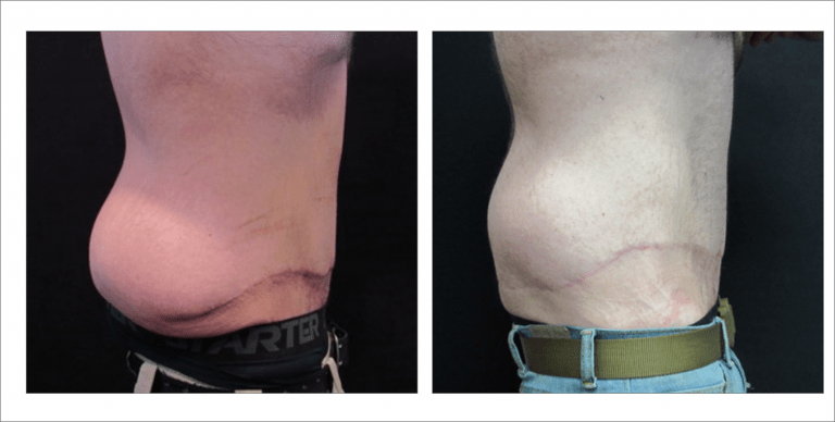 Body Enhancement Treatment in North Dakota