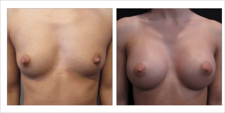 Breast Enhancement | The Aesthetic Center Bismarck, ND