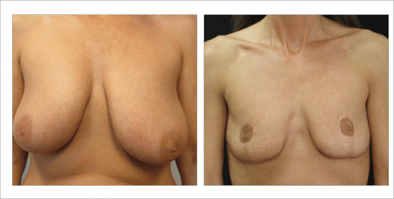 Breast Enhancement | The Aesthetic Center Bismarck, ND