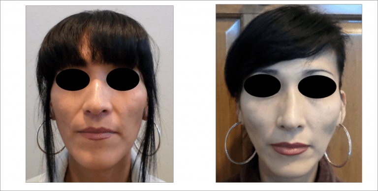 Face Enhancement | The Aesthetic Center Bismarck, ND