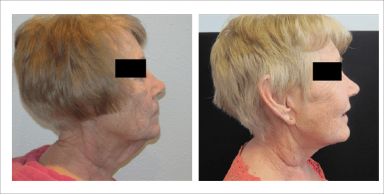 Face Enhancement | The Aesthetic Center Bismarck, ND