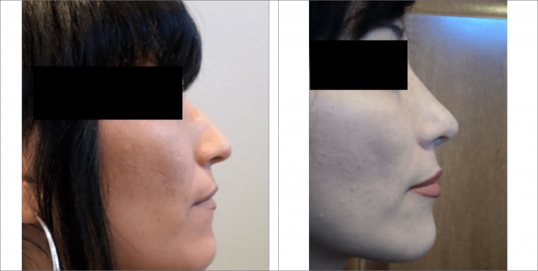 Face Enhancement | The Aesthetic Center Bismarck, ND