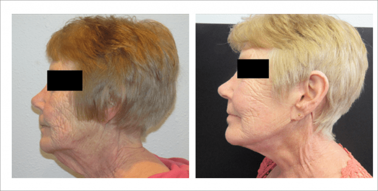 Face Enhancement | The Aesthetic Center Bismarck, ND