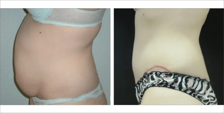 Body Enhancement Treatment in North Dakota