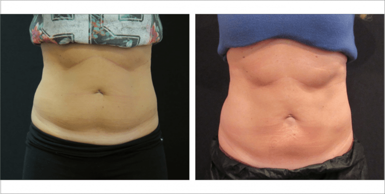 Body Enhancement | The Aesthetic Center Bismarck, ND