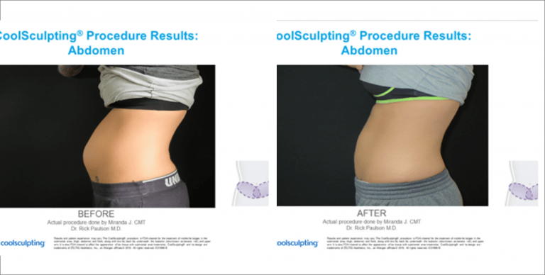 Body Enhancement | The Aesthetic Center Bismarck, ND