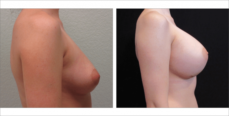 Breast Enhancement | The Aesthetic Center Bismarck, ND