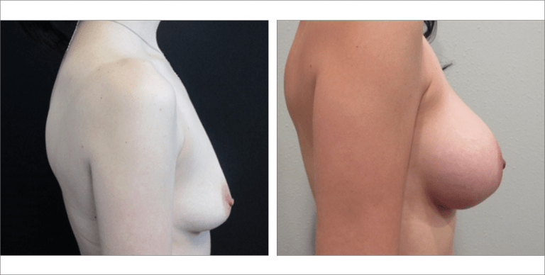 Breast Enhancement | The Aesthetic Center Bismarck, ND