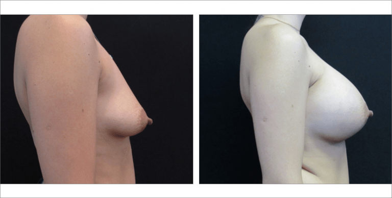 Breast Enhancement | The Aesthetic Center Bismarck, ND