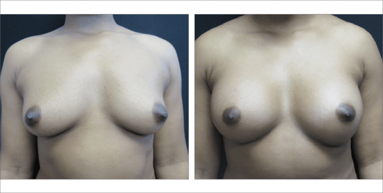 Breast Enhancement | The Aesthetic Center Bismarck, ND