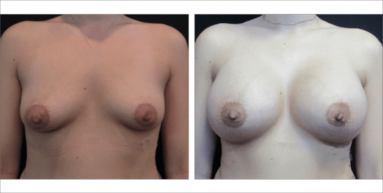 Breast Enhancement | The Aesthetic Center Bismarck, ND