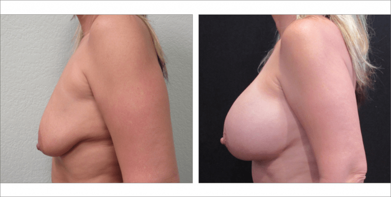 Breast Enhancement | The Aesthetic Center Bismarck, ND