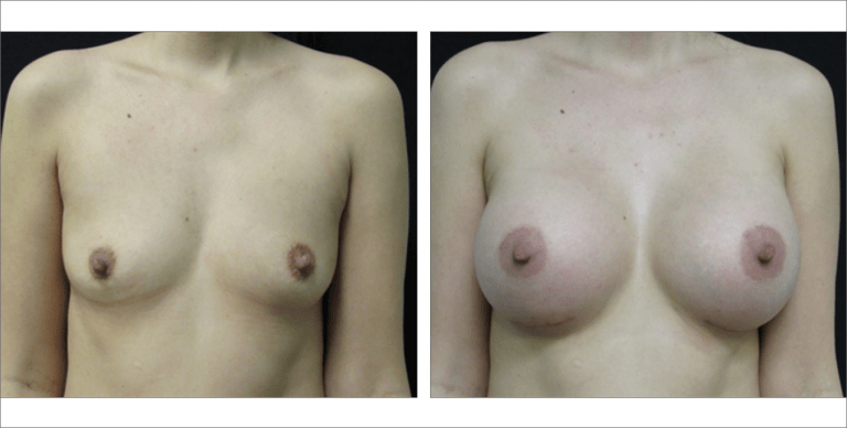 Breast Enhancement | The Aesthetic Center Bismarck, ND