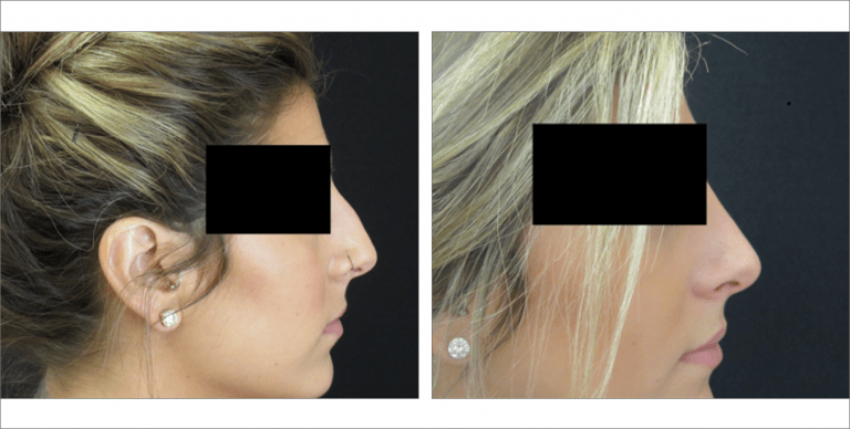 Face Enhancement | The Aesthetic Center Bismarck, ND