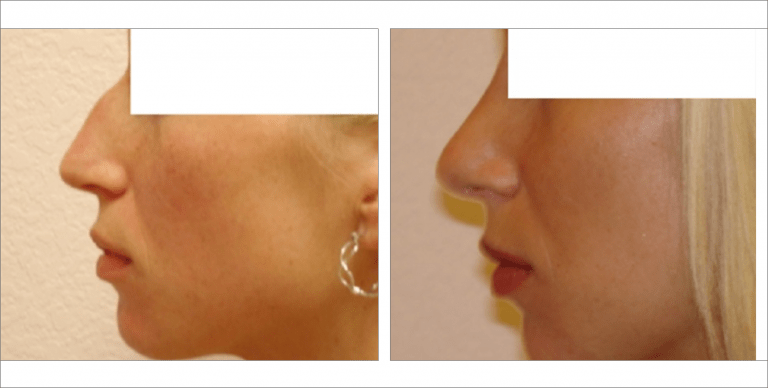 Face Enhancement | The Aesthetic Center Bismarck, ND