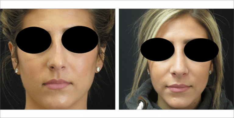 Face Enhancement | The Aesthetic Center Bismarck, ND