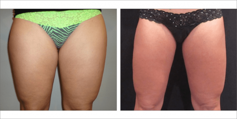 Liposuction | Bismarck, Minot, Dickinson ND - Aesthetic Center