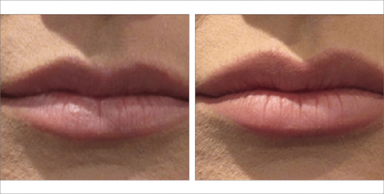 Lip Fillers before & after images