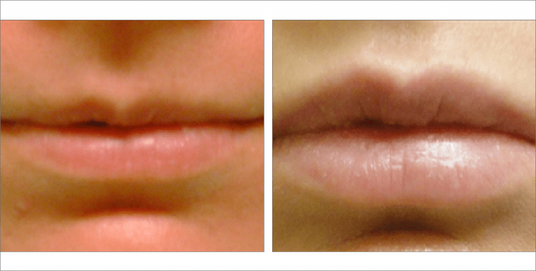 Lip Fillers before & after images