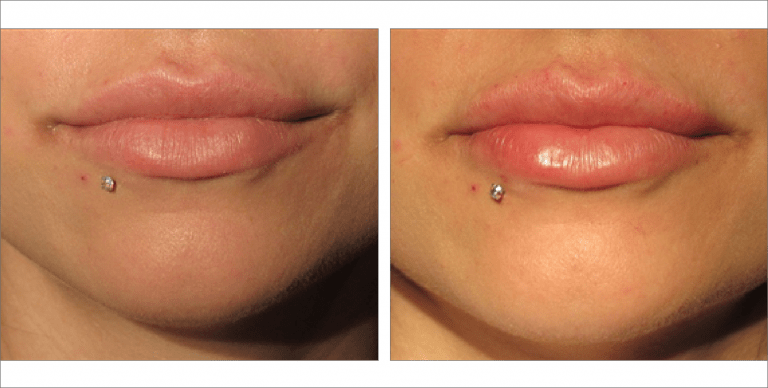 Lip Fillers before & after images