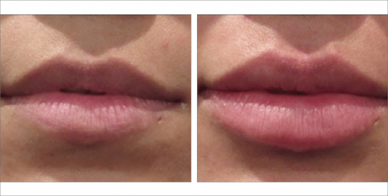 Lip Fillers before & after images