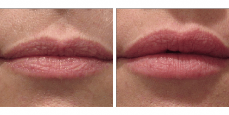 Lip Fillers before & after images