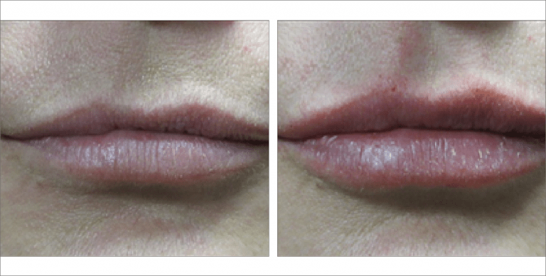 Lip Fillers before & after images