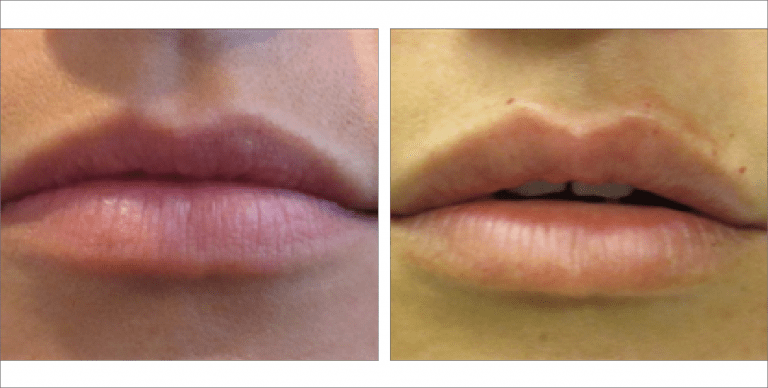 Lip Fillers before & after images