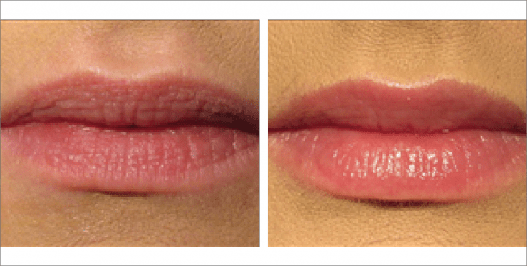 Lip Fillers before & after images