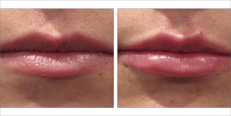 Lip Fillers before & after images