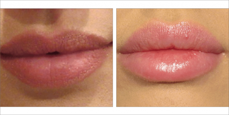 Lip Fillers before & after images