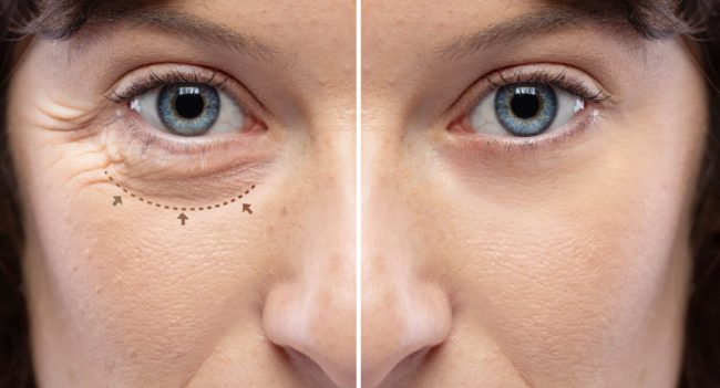 Blepharoplasty surgery | What is it? What are the benefits and risks?