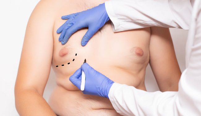 Is Gynecomastia Surgery Worth It? - The Aesthetic Center