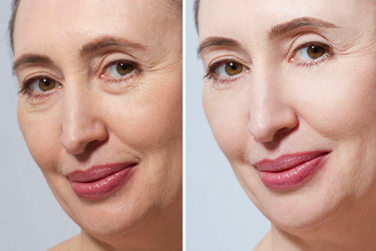 facelift procedure in the aesthetic center