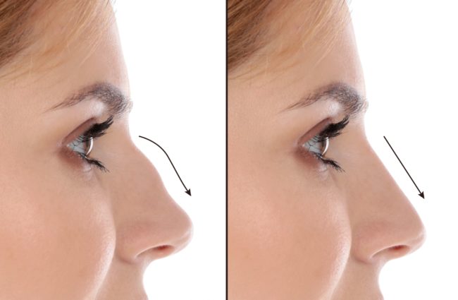 Enhancing Your Appearance and Breathing All You Need to Know About Nose Surgery