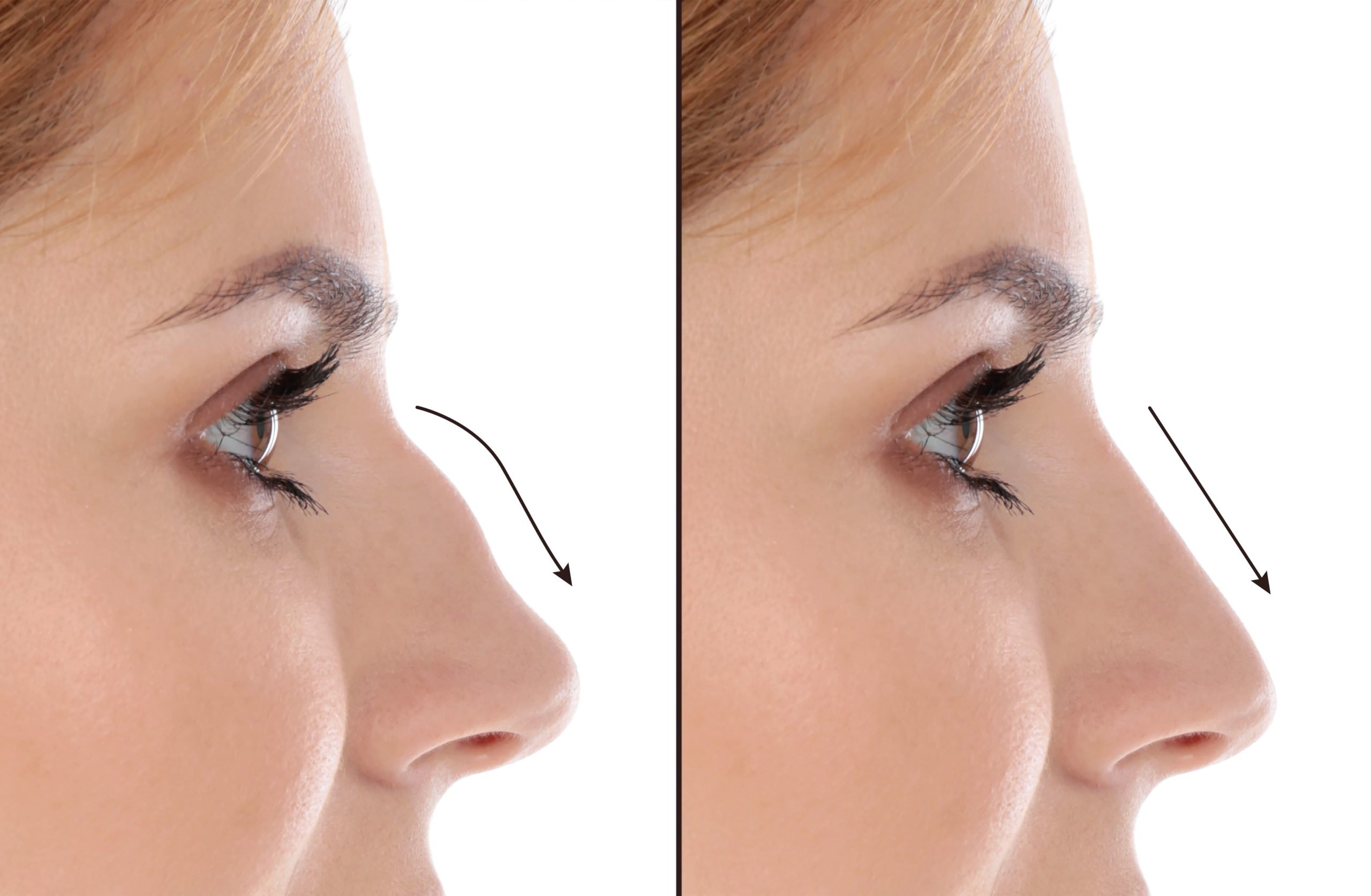 Enhancing Appearance And Breathing: Know About Nose Surgery
