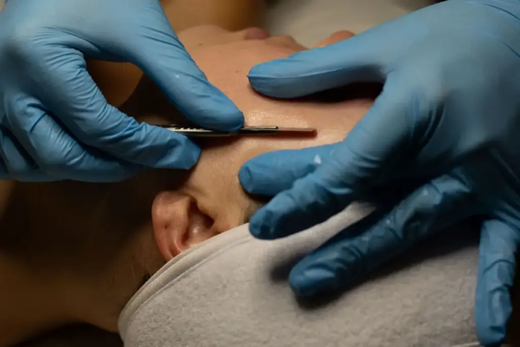 Dermaplaning treatment at Aesthetic Center ND