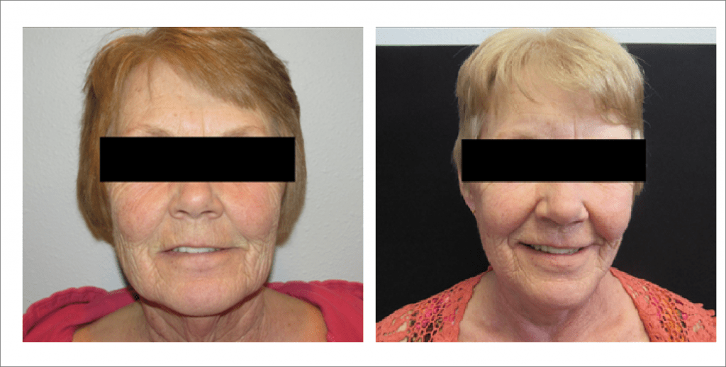 Face Enhancement | The Aesthetic Center Bismarck, ND