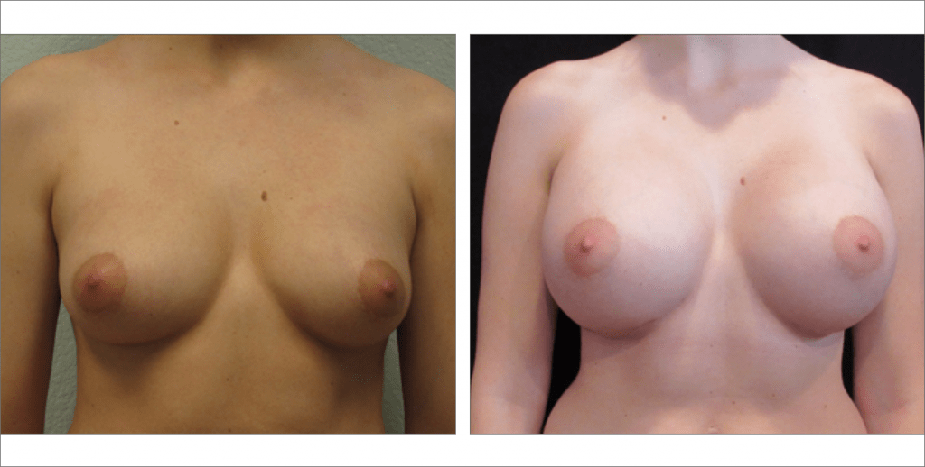 Breast Enhancement | The Aesthetic Center Bismarck, ND