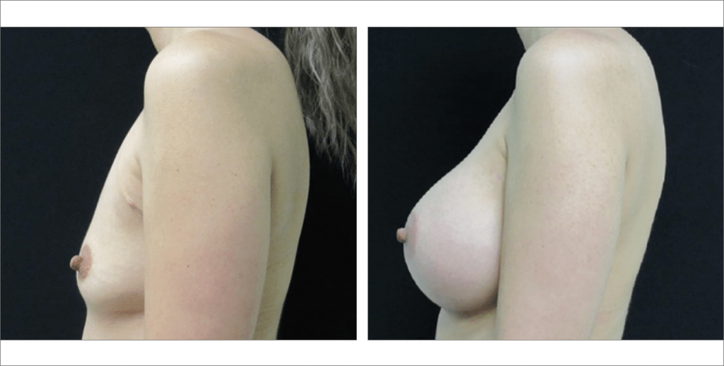 Breast Enhancement | The Aesthetic Center Bismarck, ND
