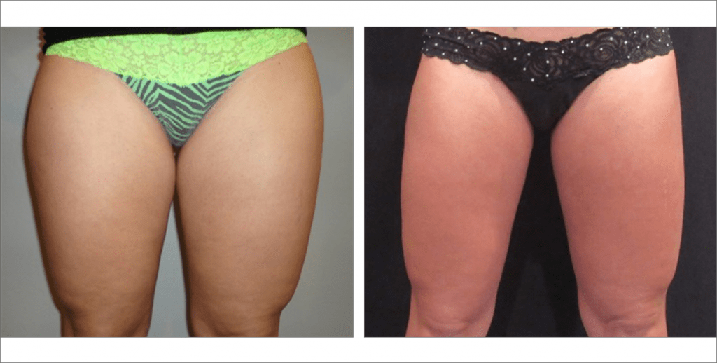 Liposuction | Bismarck, Minot, Dickinson ND - Aesthetic Center