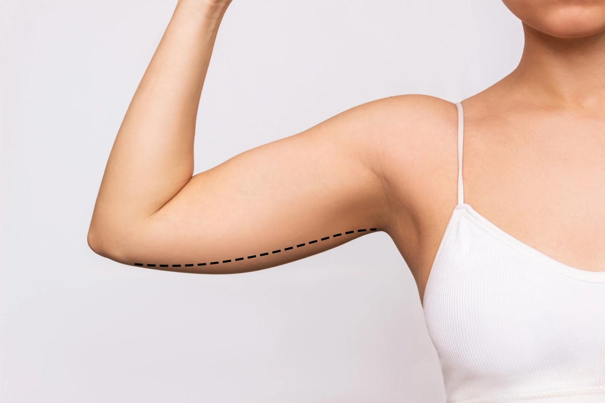 Patient Showing her Arms After Armlift Surgery at The Aesthetic Center in Bismarck ND